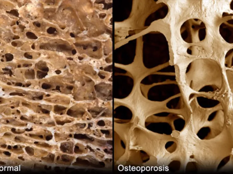 Danni da osteoporosi