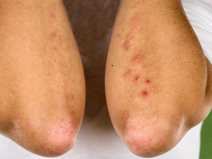 Esempio dermatite erpetiforme