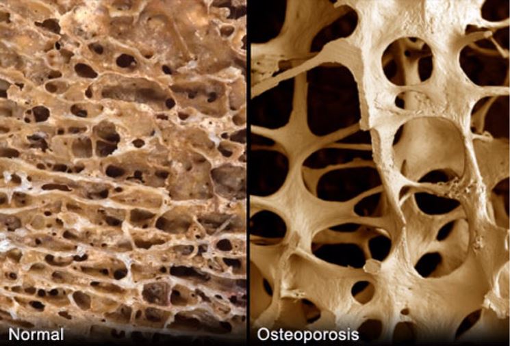 Danni da osteoporosi